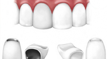 Nguyên nhân tại sao sau khi bọc răng sứ bị hở chân răng?