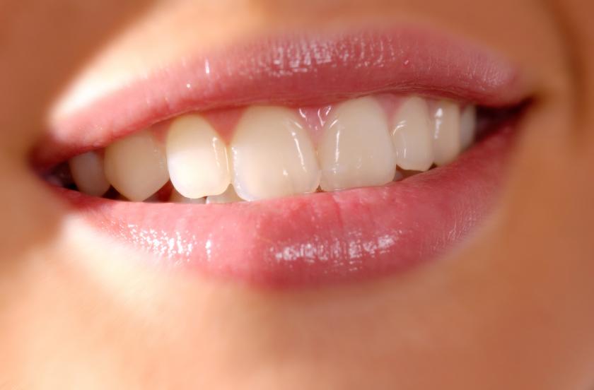 Bọc răng thế thẩm mỹ là gì? Trường hợp nào nên bọc răng sứ