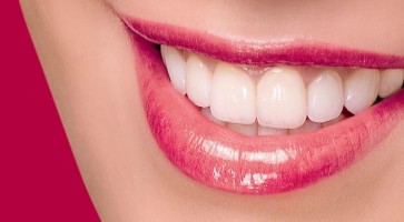 Bọc răng sứ thẩm mỹ là gì? Tại sao phải bọc răng sứ?