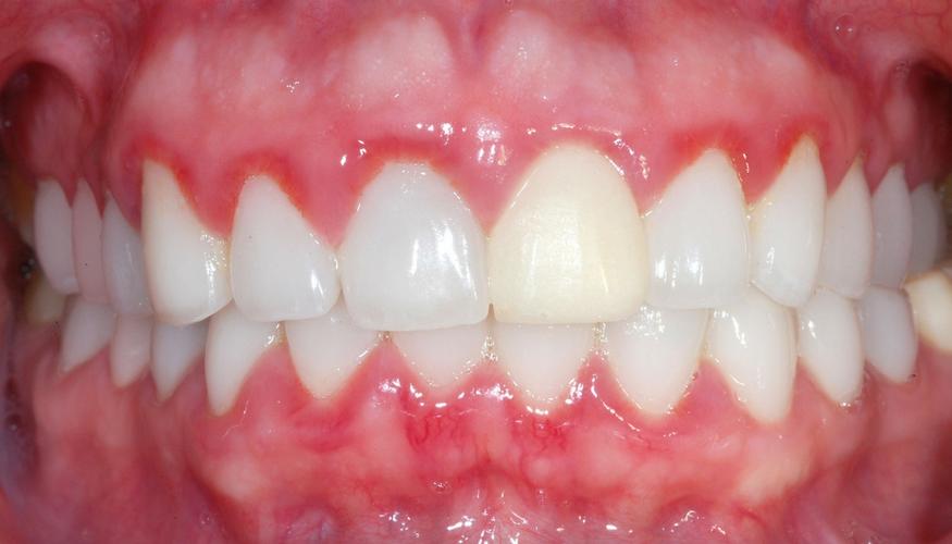 bọc răng sứ bị viêm lợi